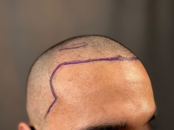 Corrective Hair Restoration: Case 2 - Before