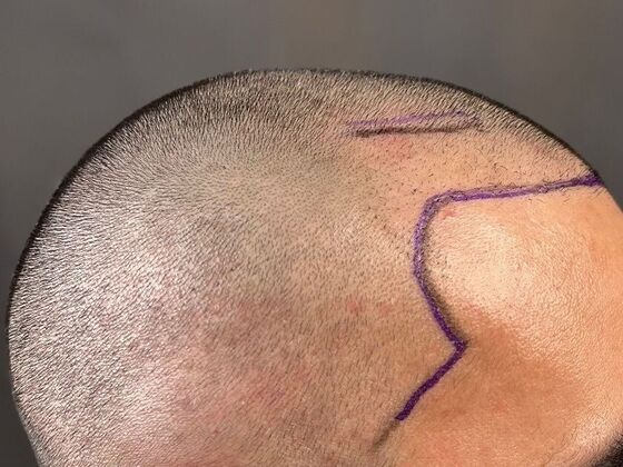 Corrective Hair Restoration: Case 2 - Before