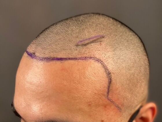 Corrective Hair Restoration: Case 2 - Before