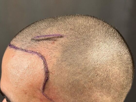 Corrective Hair Restoration: Case 2 - Before