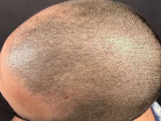 Corrective Hair Restoration: Case 2 - Before