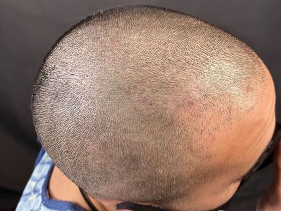 Corrective Hair Restoration: Case 2 - Before