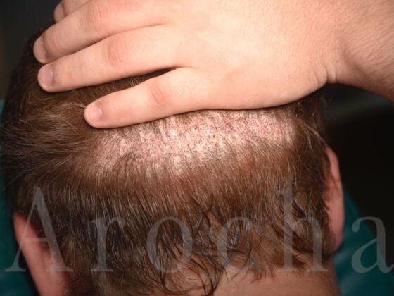 Scalp Micropigmentation Case 5 - After