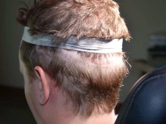 Scalp Micropigmentation Case 5 - Before