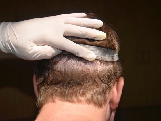 Scalp Micropigmentation: Case 5 - After