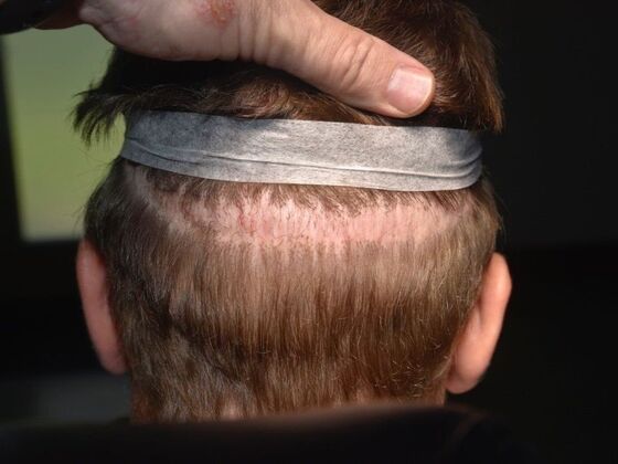 Scalp Micropigmentation: Case 5 - Before