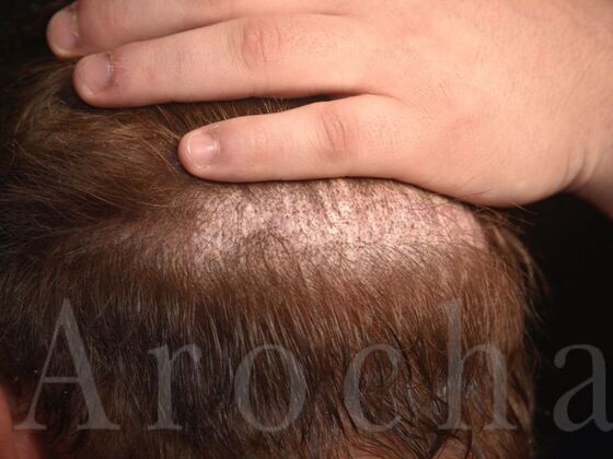 Scalp Micropigmentation: Case 5 - After