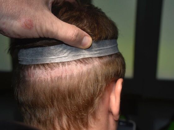 Scalp Micropigmentation: Case 5 - Before