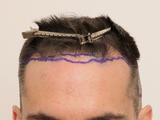 Male Before And After Hair Transplant Photos Hairline FUE (17) - Before