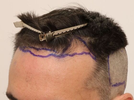 Hair Transplant - Male: Hairline FUE - Case 17 - Before FUE hair transplant