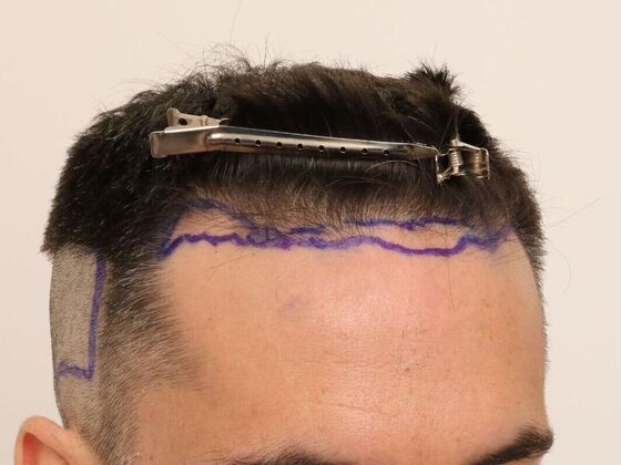 Hair Transplant - Male: Hairline FUE - Case 17 - Before FUE hair transplant