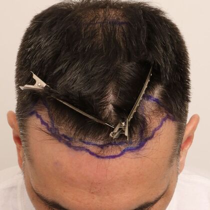Hair Transplant - Male: Hairline FUE - Case 17 - Before FUE hair transplant
