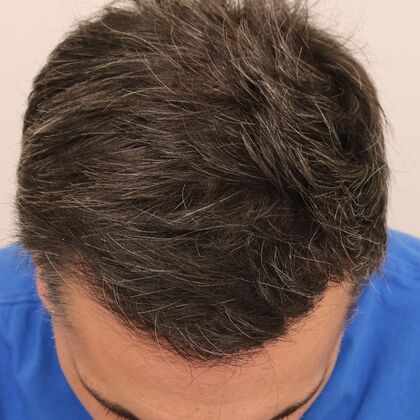 Hair Transplant - Male: Hairline FUE - Case 17 - After FUE hair transplant