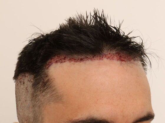 Hair Transplant - Male: Hairline FUE - Case 17 - Post-op FUE hair transplant