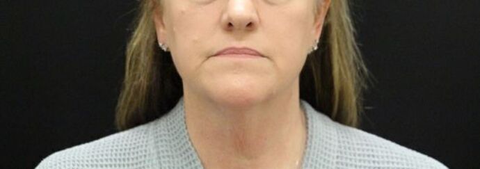 Face & Neck Lifts: Case 24 - Before