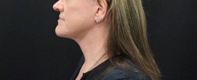 Face & Neck Lifts Case 24 - After