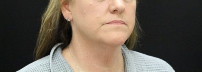 Face & Neck Lifts: Case 24 - Before