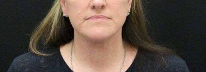 Face & Neck Lifts: Case 24 - After