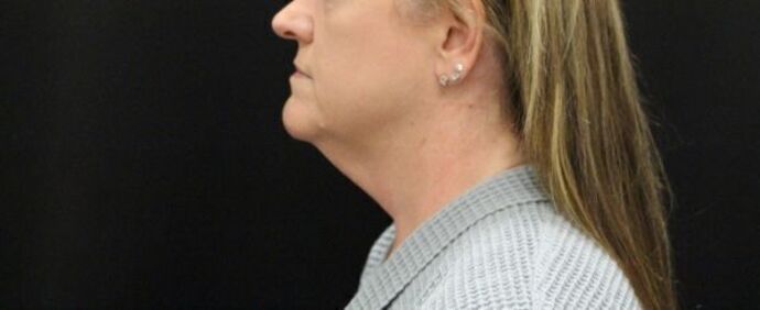 Face & Neck Lifts Case 24 - Before