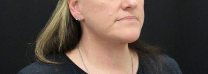 Face & Neck Lifts: Case 24 - After