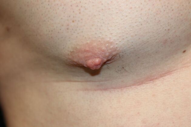NIPPLE REDUCTION: Case 3 - Before
