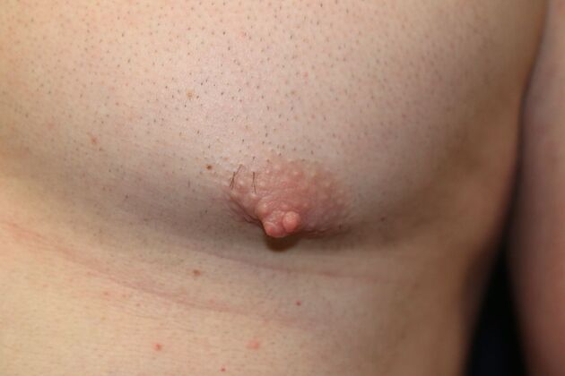 NIPPLE REDUCTION: Case 3 - Before