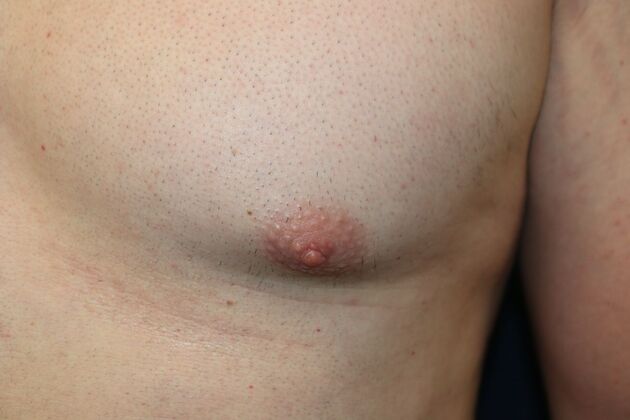 NIPPLE REDUCTION: Case 3 - After