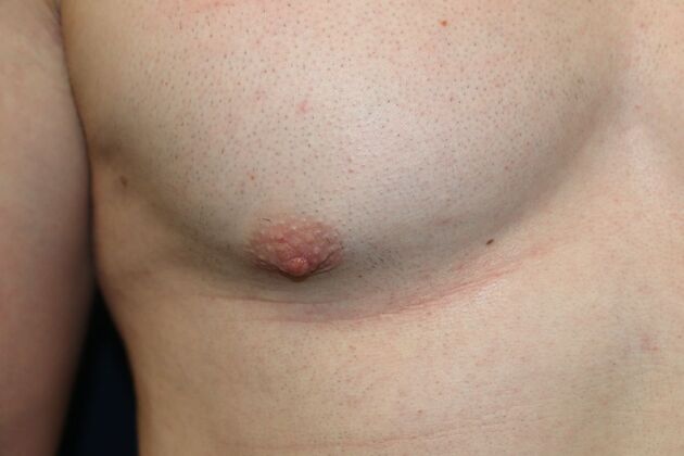 NIPPLE REDUCTION: Case 3 - After