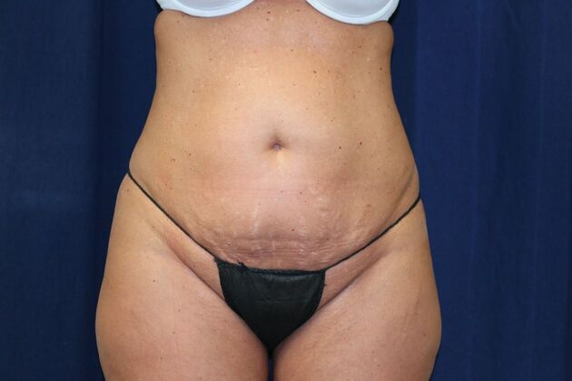 Tummy Tuck*: Case 4 - Before