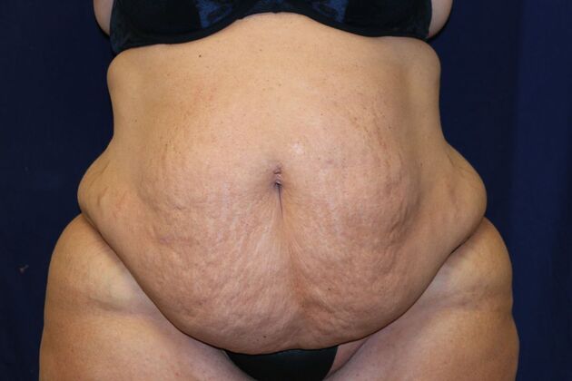 Tummy Tuck*: Case 5 - Before