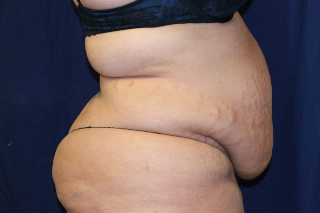 Tummy Tuck*: Case 5 - Before