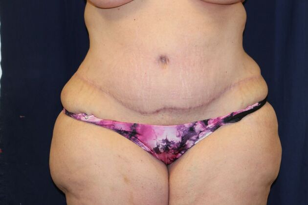 Tummy Tuck*: Case 5 - After