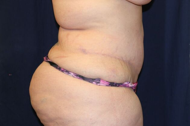 Tummy Tuck*: Case 5 - After