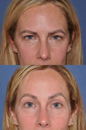 Endoscopic Browlift: Endoscopic Browlift - Before and after