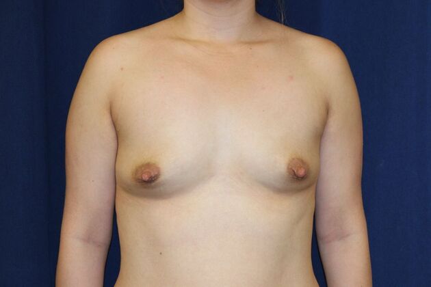Breast Augmentation*: Case 75 - Before
