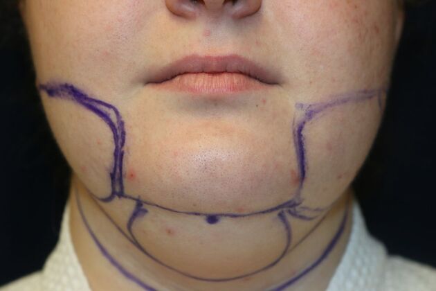 Neck Sculpting : Case 7 - Before