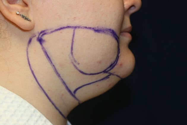 Neck Sculpting : Case 7 - Before
