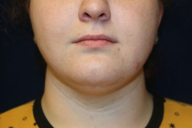 Neck Sculpting : Case 7 - After