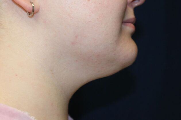 Neck Sculpting : Case 7 - After