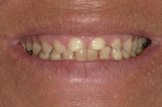 Full Mouth Reconstruction: Case 34 - Before