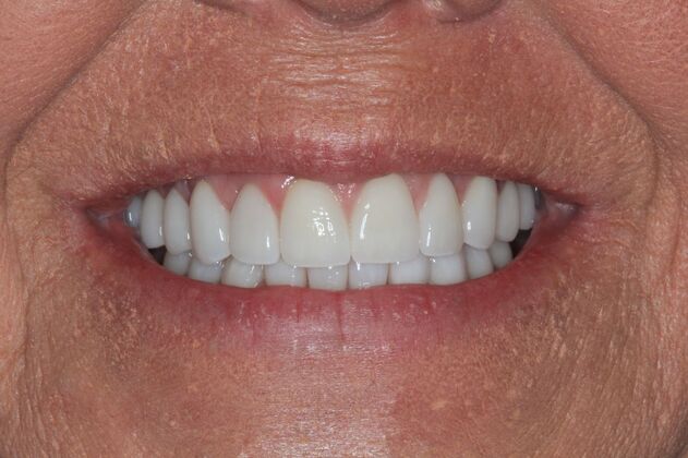 Full Mouth Reconstruction: Case 34 - After