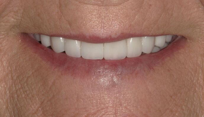 Full Mouth Reconstruction Case 35 - After