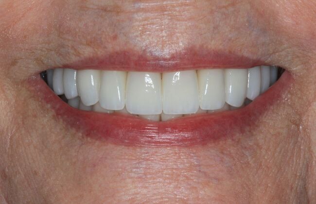 Full Mouth Reconstruction: Case 36 - After