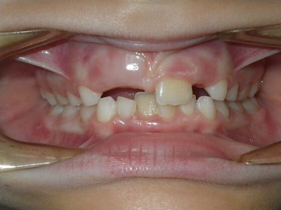 Orthodontic treatment in Phases: Case 10 - Before