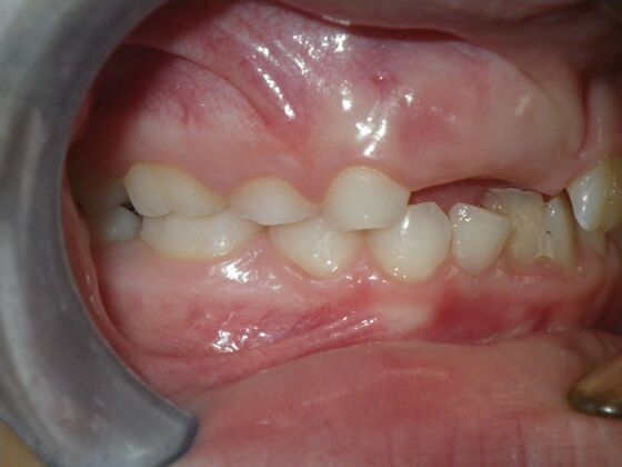 Orthodontic treatment in Phases: Case 10 - Before