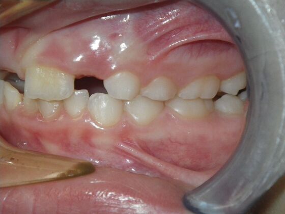 Orthodontic treatment in Phases: Case 10 - Before