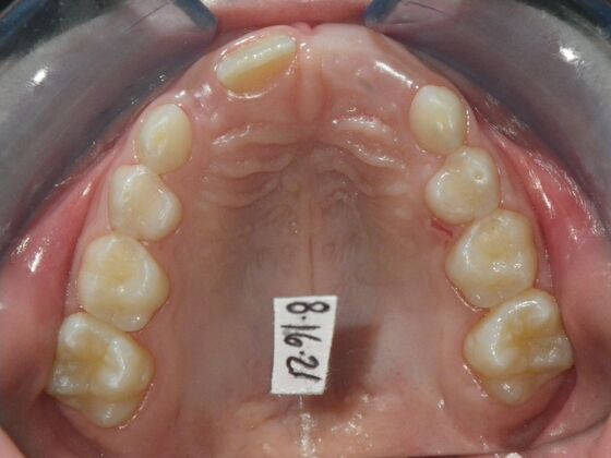 Orthodontic treatment in Phases: Case 10 - Before