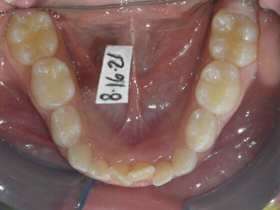 Orthodontic treatment in Phases: Case 10 - Before