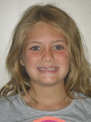 Orthodontic treatment in Phases: Case 10 - Before