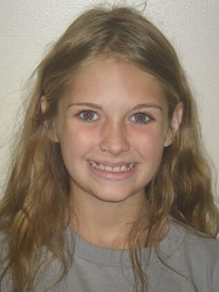 Orthodontic treatment in Phases: Case 10 - After